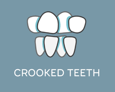 Crooked Teeth image