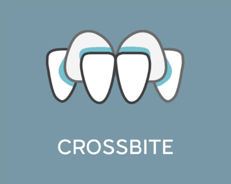 Crossbite image