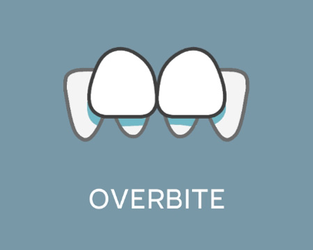 Overbite image
