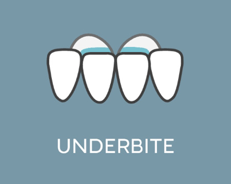 Underbite image